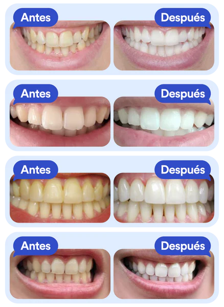 Dentalwhite - El primer blanqueador con tecnologia ultravioleta. Olvidate de los dientes amarillos y consigue una sonrisa vitaldent que todos envidiaran con solo 20 min al dia