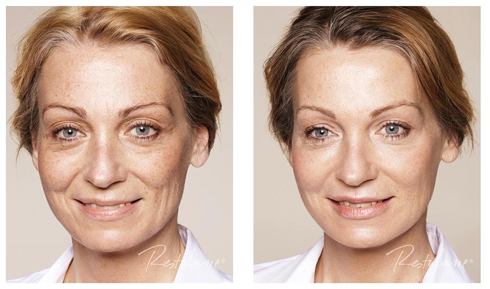 1+1 GRATIS Antiagepro™- El primer lápiz de colágeno con tecnología lifting que eliminan los surcos de la boca en 10 min , olvidate de los trataientos agresivos y quimicos